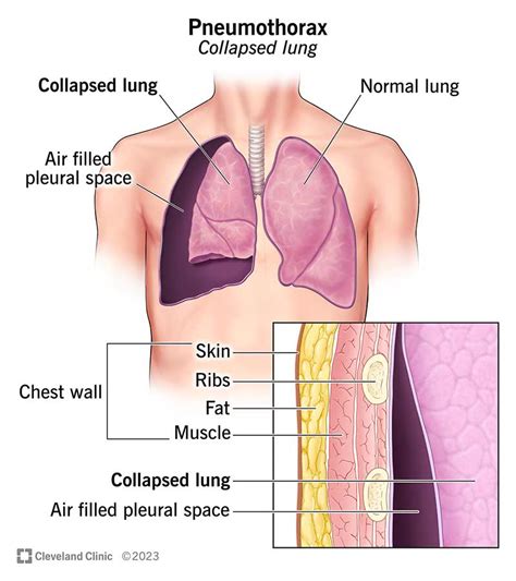 Pneumothorax (Collapsed Lung): Symptoms & Treatment