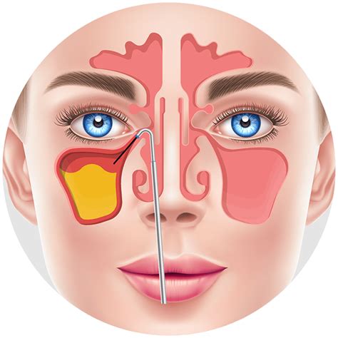 Balloon Sinuplasty for Snoring in Houston | Kaplan Sinus Relief