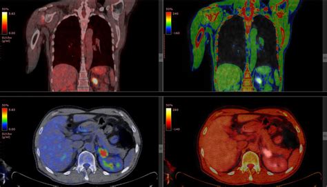 Understanding Your FDG PET Scan