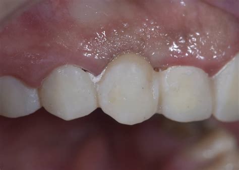 Dental Esthetics: Ovate pontic for the correct emergence profile.. A clinical case