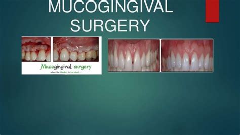 Mucogingival surgery in periodontics