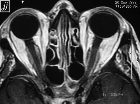 Optic nerve sheet tumor – Radiopaedia