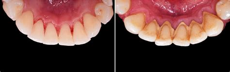 The possible of causes of Gum Disease - London Specialist Dentists