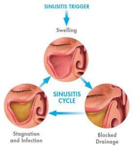 Sinus Infection Diagnosis | North Fulton ENT