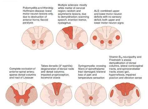 MBBS Medicine (Humanity First): Spinal Cord Lesions - USMLE high yield concepts | Spinal cord ...