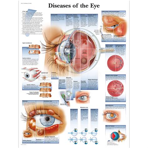 Diseases of the Eye Chart - 4006666 - 3B Scientific - VR1231UU ...