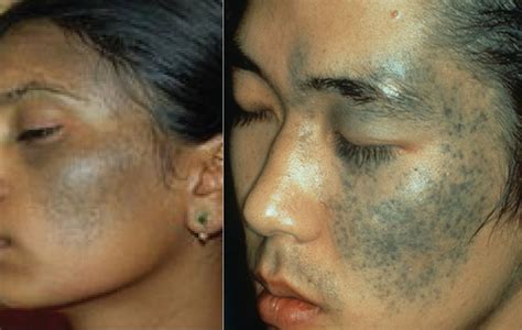 Mongolian Birthmark/Spot on Babies, Meaning, Pictures, Myths, Removal & Treatment