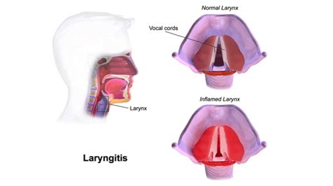 Laryngitis : Causes, Picture, Symptoms And Treatment