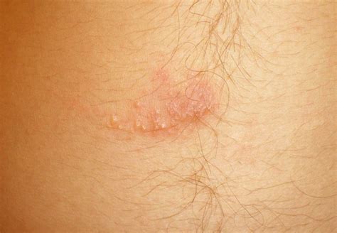 Scabies Rash - Pictures, Treatment, Contagious, Home Remedies