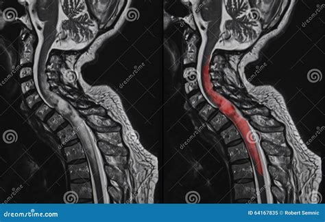 Spinal cord tumor, MRI stock image. Image of care, cord - 64167835