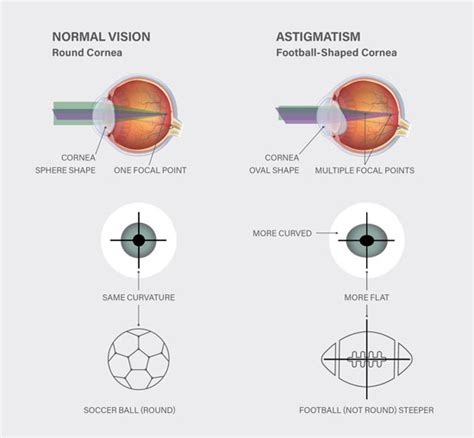 Astigmatism Explained | KindSIGHT Eye Specialists