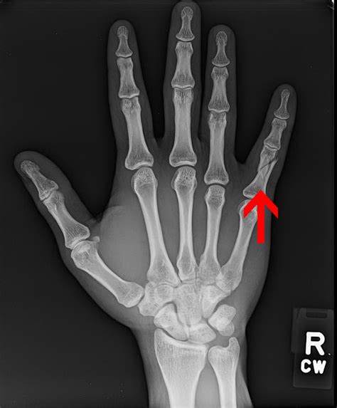 Hand Fractures Treatment and Surgery Specialists in Northern VA