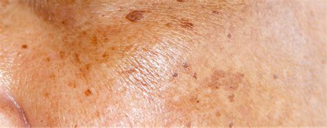 Brown Skin Spots - When not to worry about the brown spots on your skin