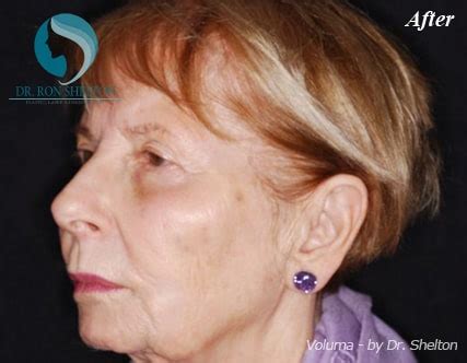 Voluma Fillers NYC | Anti Aging Treatments NYC by Dr Ron Shelton