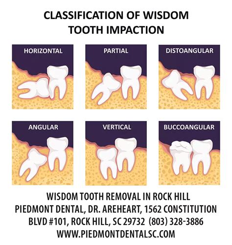 Wisdom Teeth Removal in Rock Hill, SC » Rock Hill Family Dentist ...