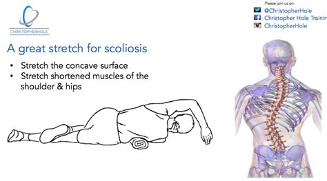 Scoliosis: The basics of an exercise program - Christopher Hole Training