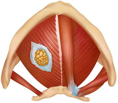 Herniation of mylohyoid muscle. | Download Scientific Diagram