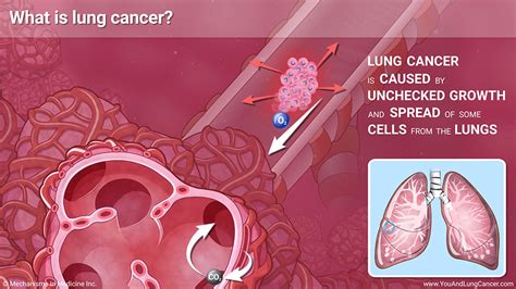 Slide Show - Understanding Small Cell Lung Cancer