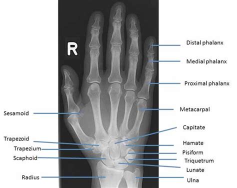 Xray Of Hand Bones