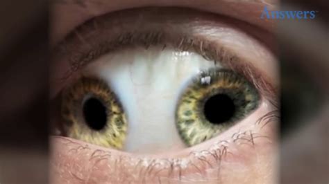 Rare Eye Conditions You Have To See To Believe - YouTube