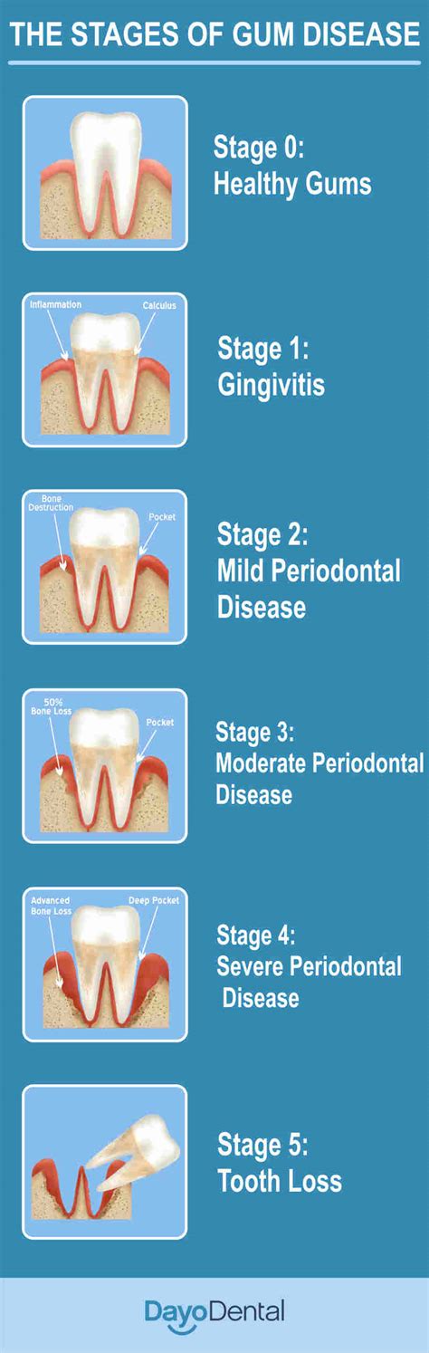 Periodontal Disease Stages