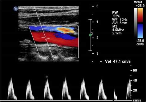 Carotid artery occlusion