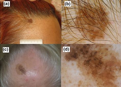 Melanoma on scalp pictures: early stage 1, scalp melanoma images, melanoma on neck pictures ...