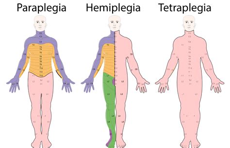 Tetraplegia - Wikiwand