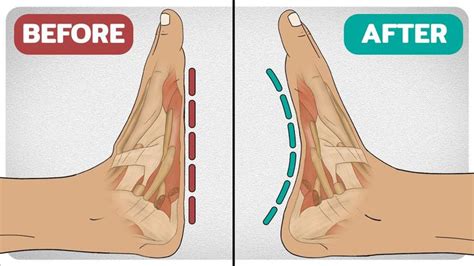 5 Exercises To Fix Flat-Feet (Fallen Arches) | Foot exercises, Flat feet exercises, Fallen arches