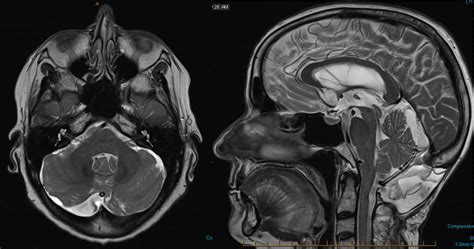 Cerebellar Arachnoid Cyst