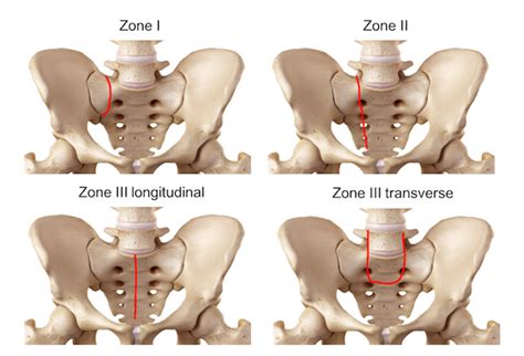 Sacrum fracture