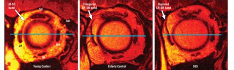 Sagging Eye Syndrome: Causes, Symptoms, Diagnosis & Treatment - Daily Medicos