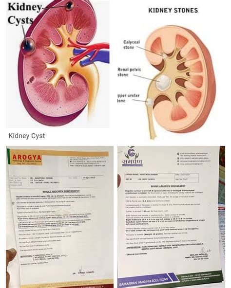 👆 KIDNEY CYST & STONE CASE RESPONDED SUCCESSFULLY