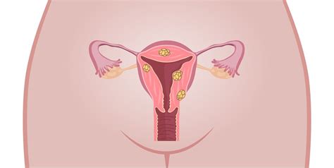 9 Facts About Fibroid Tumors | Prevention