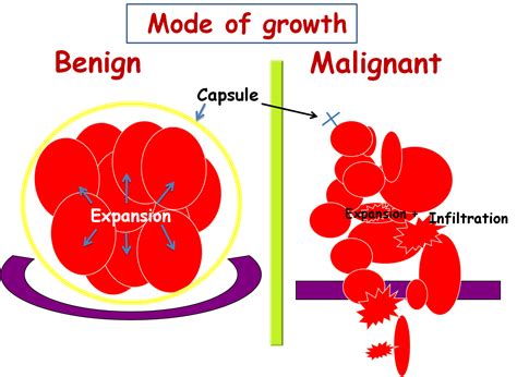 Benign Tumor Vs Malignant Tumor : Know the Fact - Indo 2 Africa Medical ...