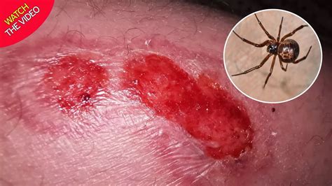 False widow spider bite explodes with pus after dad pops blister with paper clip - Mirror Online