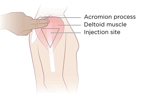 Intramuscular Injection: Definition and Patient Education