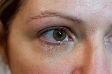 Harmless small white bumps appearing under the eyes or on the eyelids are known as milia. They ...