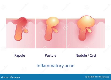 Papule Acne Vector Illustration Isolated On White Background. | CartoonDealer.com #276174492