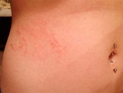 Rash on Stomach - Pictures, Treatment, Symptoms, Causes