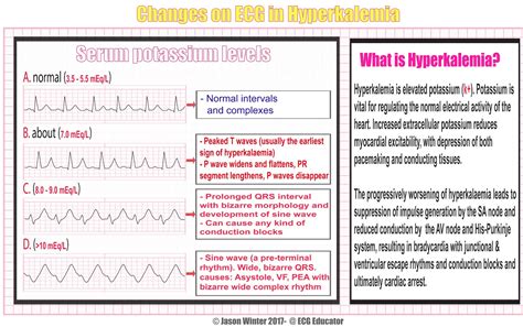 Hyperkalemia Causes Signs Symptoms Ecg Changes And