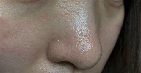 What are some treatments for deep acne scarring and enlarged pores on the nose? (photo) - human