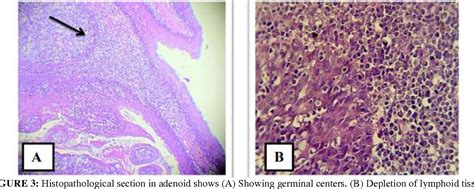 Adenoid Histology