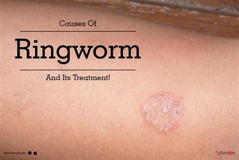 Causes Of Ringworm And Its Treatment! - By Dr. Shivashankar B. Sajjanshetty | Lybrate