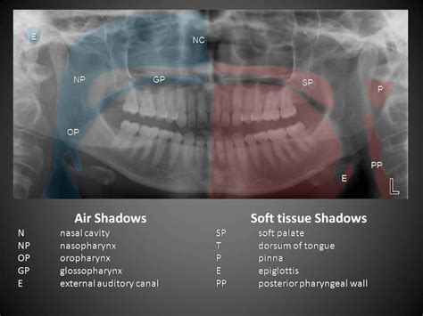 Pin on Radiographic Anatomy