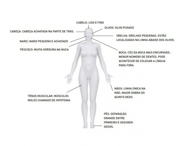 caracteristicas del sindrome de down