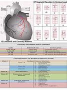 Image result for 12 Lead EKG Clip Art