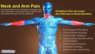 Image result for Neck Shoulder Arm Pain