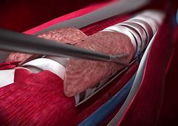 Image result for Endoscopic Thyroidectomy