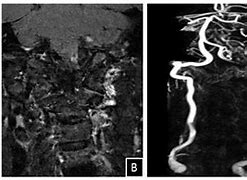 Image result for Vertebral Artery Dissection Symptoms